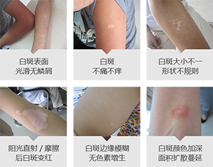 宝宝脸上有白斑是白癜风吗?